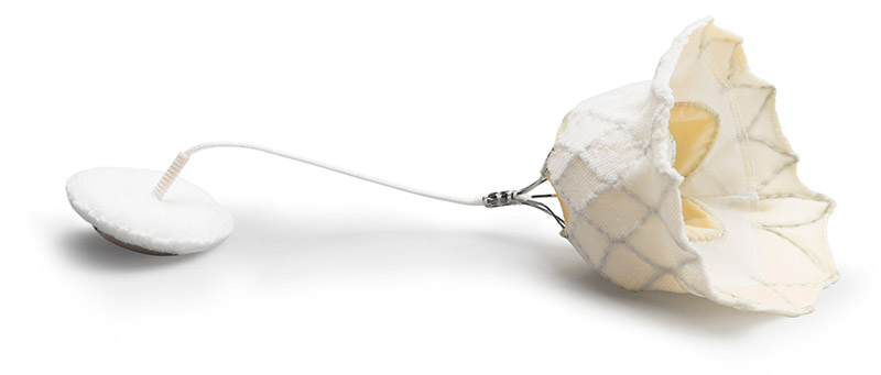 Tendyne Transcatheter Mitral Valve Replacement