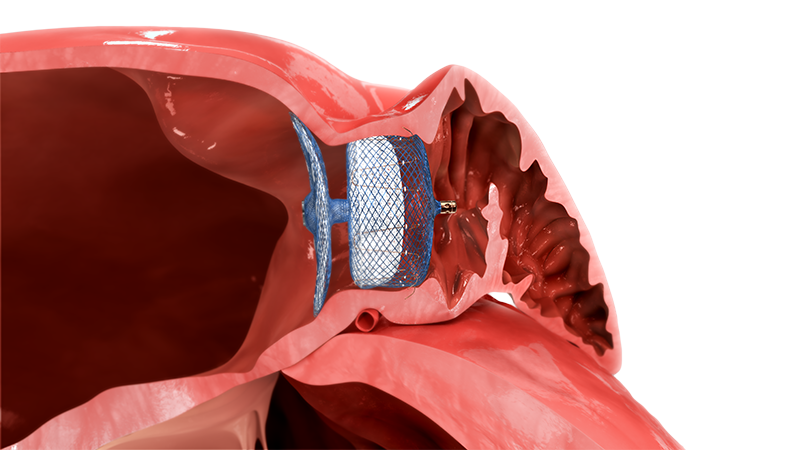Amplatzer Amulet LAA Occluder  Left Atrial Appendage Closure