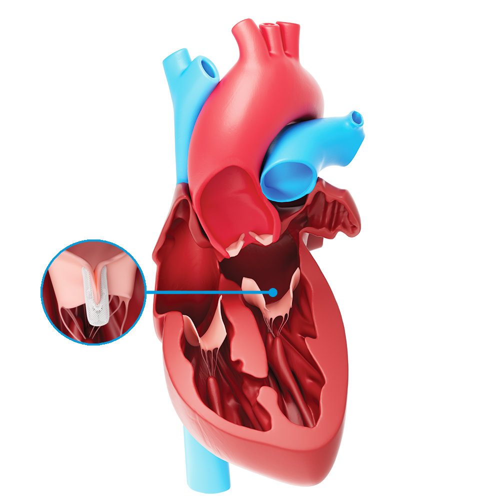 Mitral Valve Repair Mitral Regurgitation